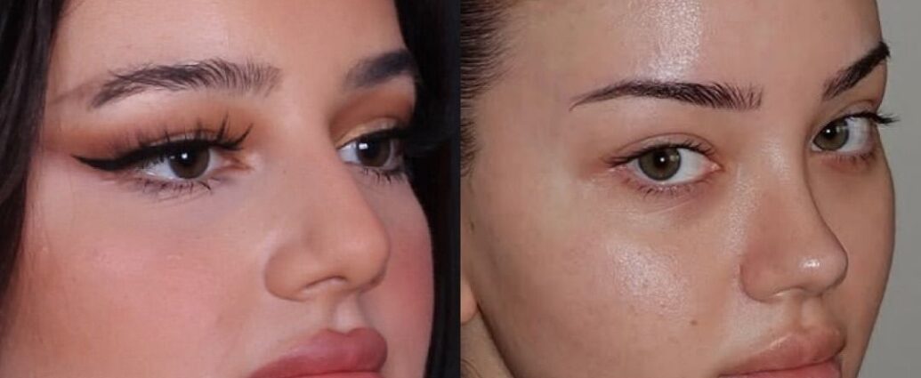 cat eye operation cost in united states