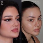 cat eye operation cost in united states