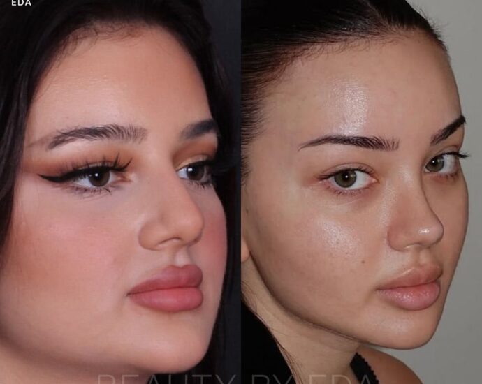 cat eye operation cost in united states