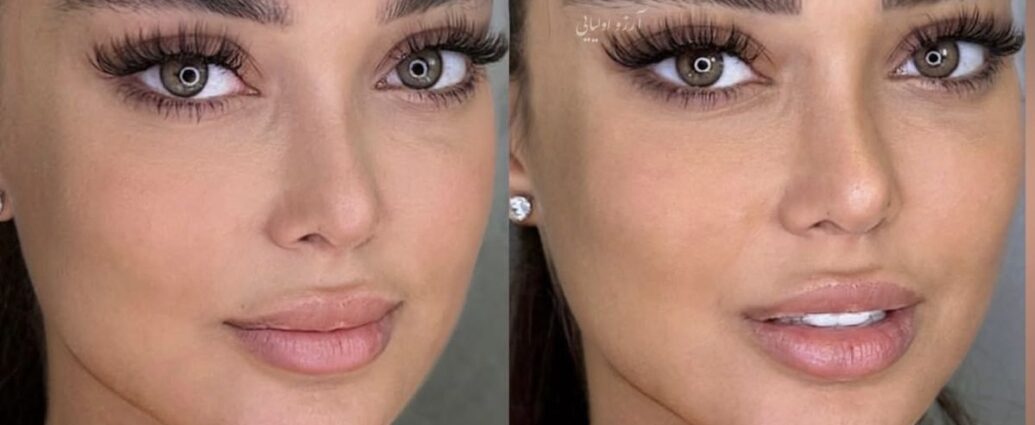 cat eye operation