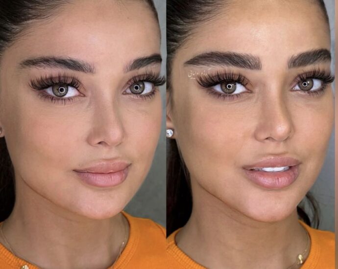 cat eye operation